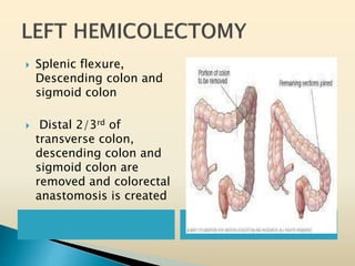  Splenic flexure,
Descending colon and
sigmoid colon
 Distal 2/3rd of
transverse colon,
descending colon and
sigmoid colon are
removed and colorectal
anastomosis is created
 