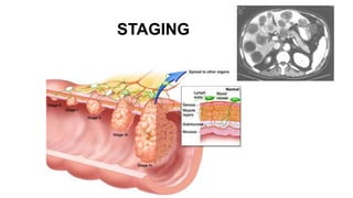 Colorectal carcinoma  anatomy to management