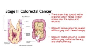 Colorectal carcinoma  anatomy to management