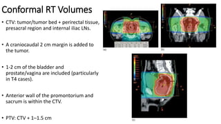 Conformal RT Volumes
• CTV: tumor/tumor bed + perirectal tissue,
presacral region and internal iliac LNs.
• A craniocaudal 2 cm margin is added to
the tumor.
• 1-2 cm of the bladder and
prostate/vagina are included (particularly
in T4 cases).
• Anterior wall of the promontorium and
sacrum is within the CTV.
• PTV: CTV + 1–1.5 cm
 