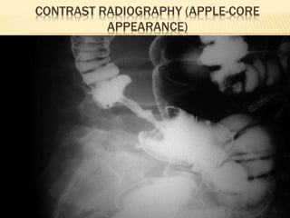 CONTRAST RADIOGRAPHY (APPLE-CORE
APPEARANCE)
 