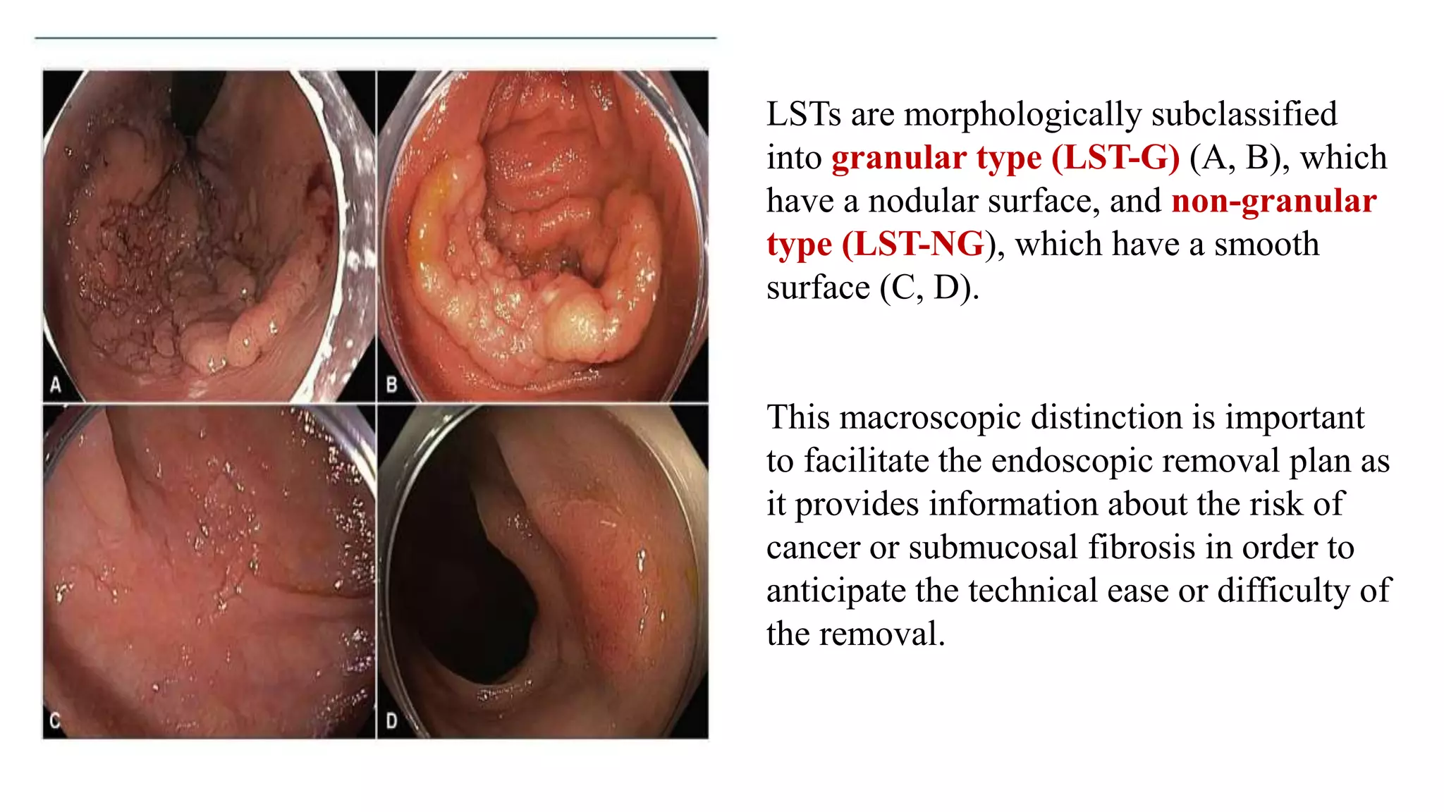 LSTs are morphologically subclassified
into granular type (LST-G) (A, B), which
have a nodular surface, and non-granular
type (LST-NG), which have a smooth
surface (C, D).
This macroscopic distinction is important
to facilitate the endoscopic removal plan as
it provides information about the risk of
cancer or submucosal fibrosis in order to
anticipate the technical ease or difficulty of
the removal.
 