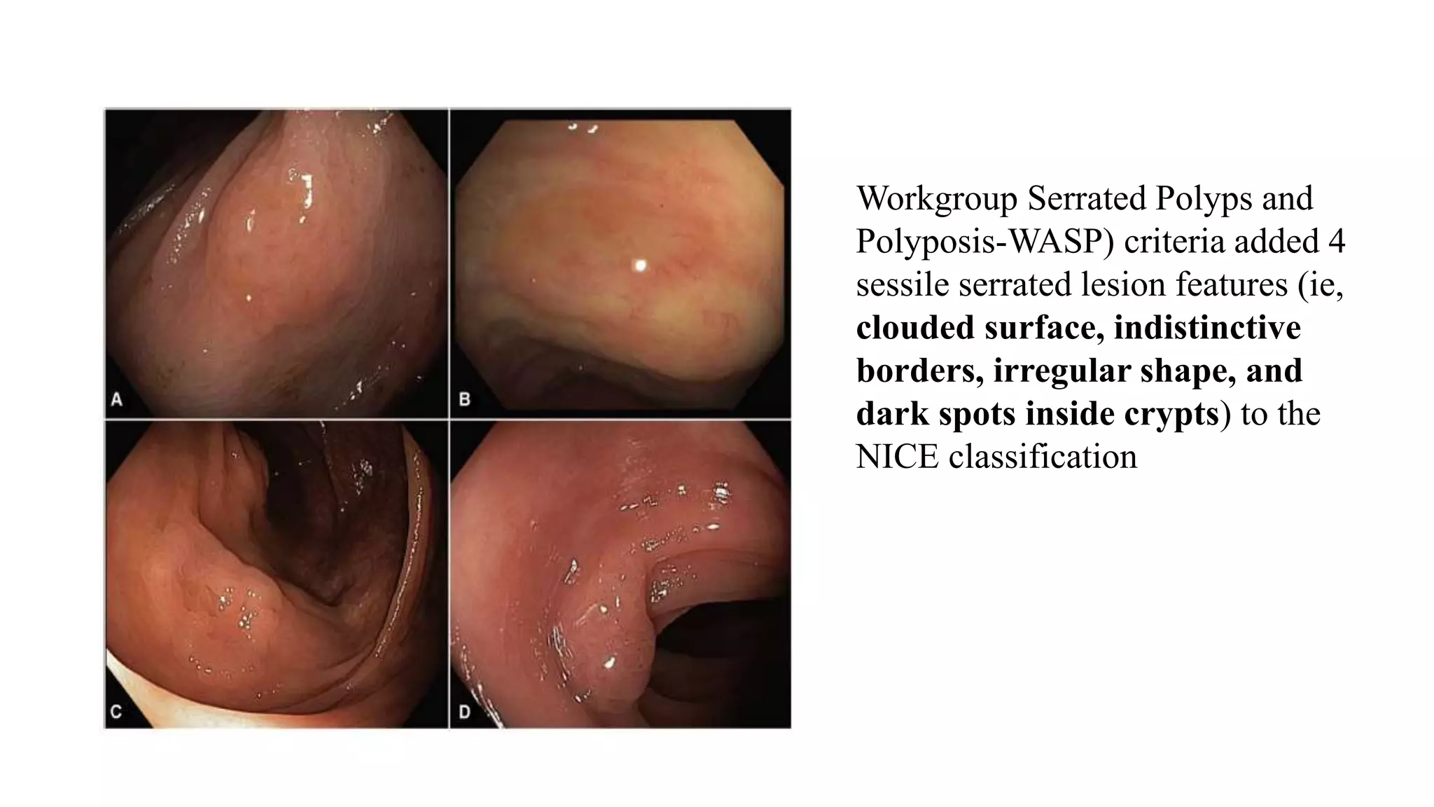 Workgroup Serrated Polyps and
Polyposis-WASP) criteria added 4
sessile serrated lesion features (ie,
clouded surface, indistinctive
borders, irregular shape, and
dark spots inside crypts) to the
NICE classification
 