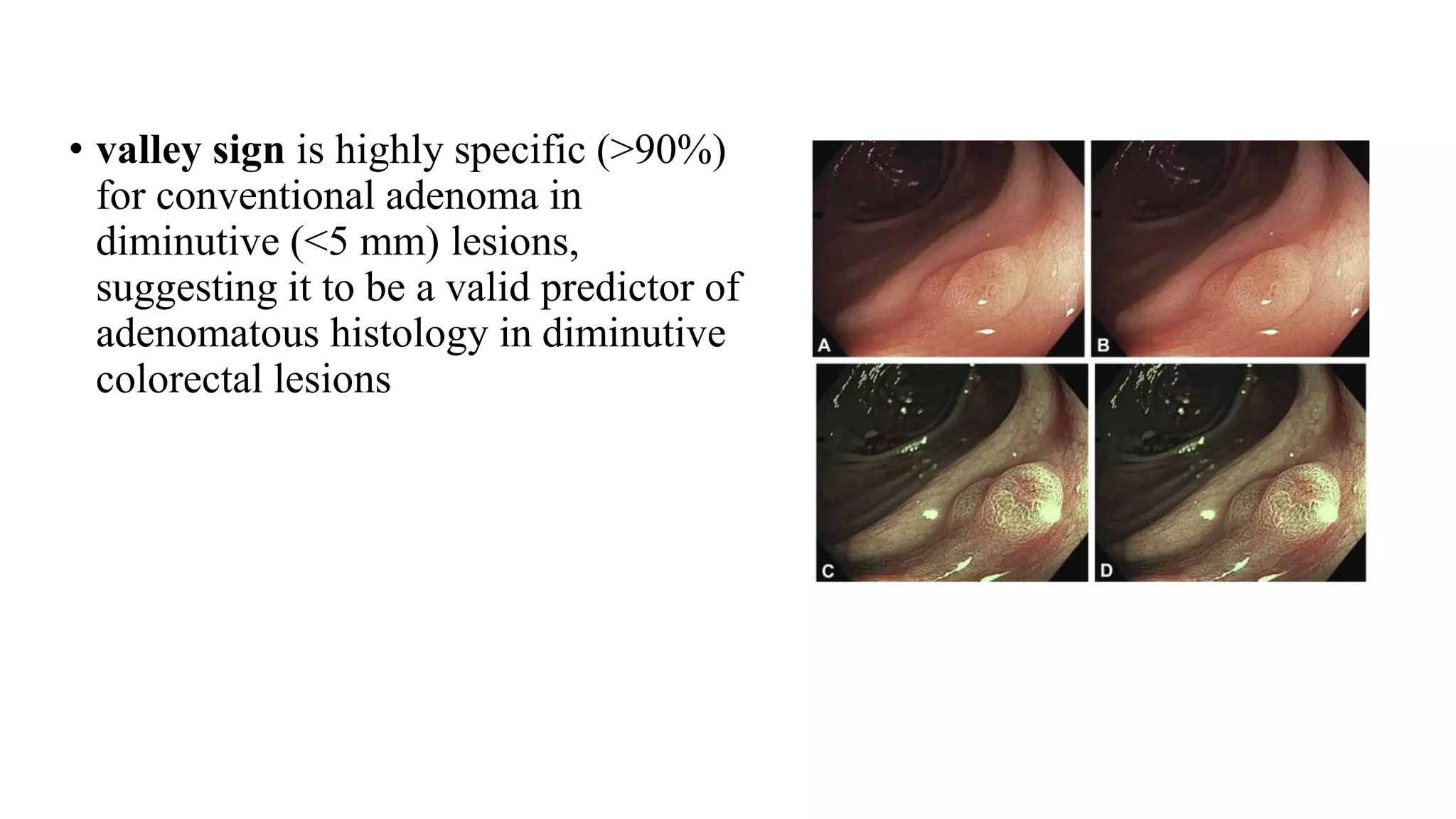 • valley sign is highly specific (>90%)
for conventional adenoma in
diminutive (<5 mm) lesions,
suggesting it to be a valid predictor of
adenomatous histology in diminutive
colorectal lesions
 