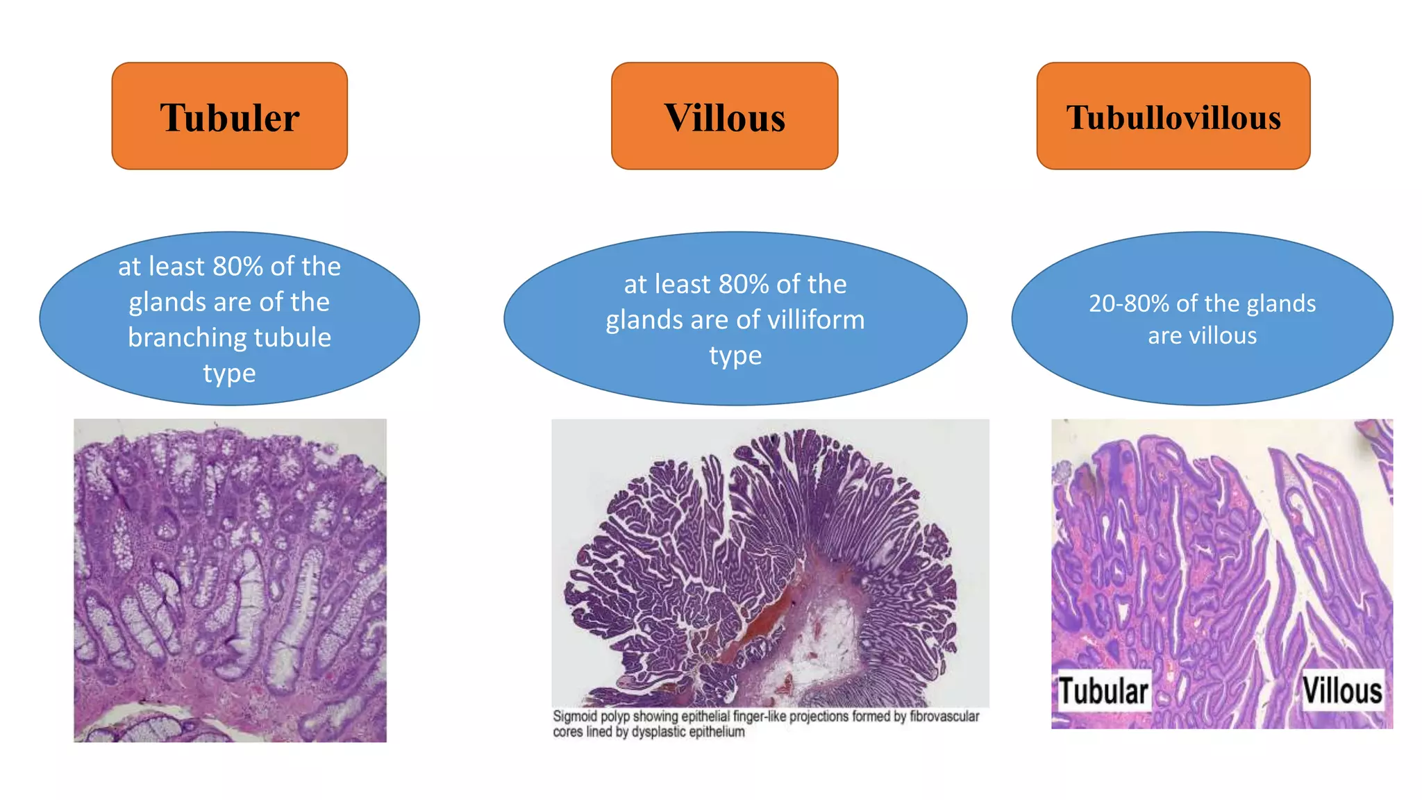 Tubuler Villous Tubullovillous
at least 80% of the
glands are of the
branching tubule
type
20-80% of the glands
are villous
at least 80% of the
glands are of villiform
type
 