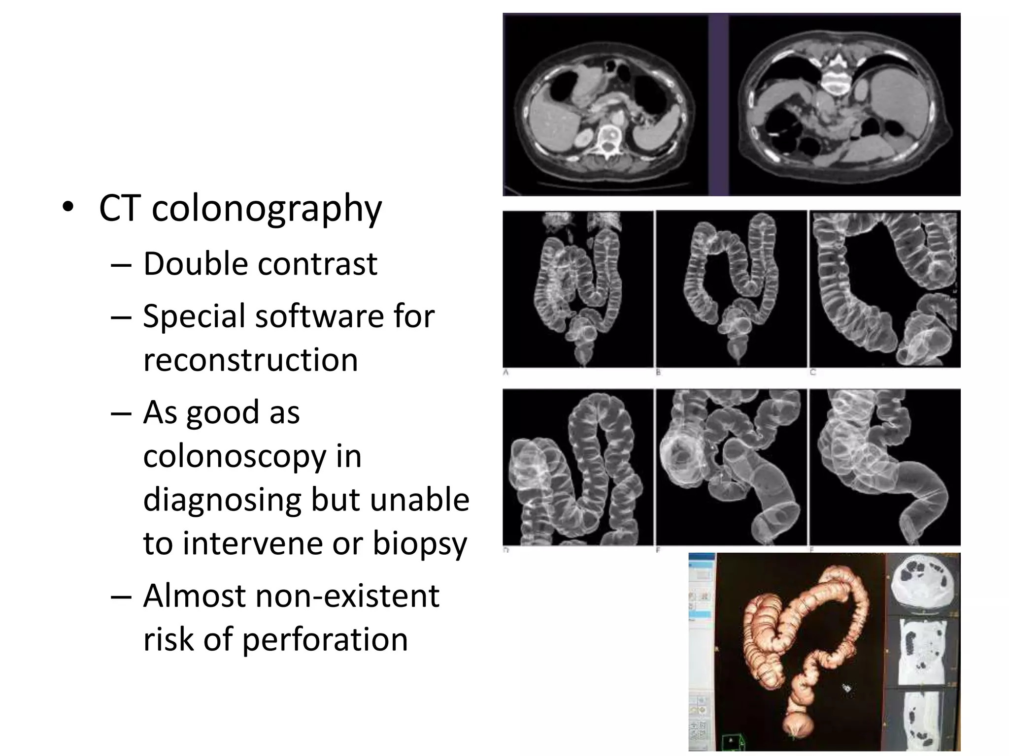 • CT colonography
– Double contrast
– Special software for
reconstruction
– As good as
colonoscopy in
diagnosing but unable
to intervene or biopsy
– Almost non-existent
risk of perforation
 
