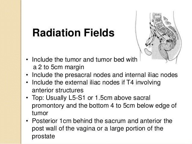 Radiation for Colon and Rectal Cancer