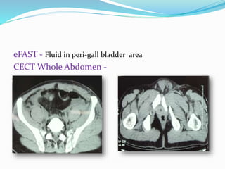 eFAST - Fluid in peri-gall bladder area
CECT Whole Abdomen -
 