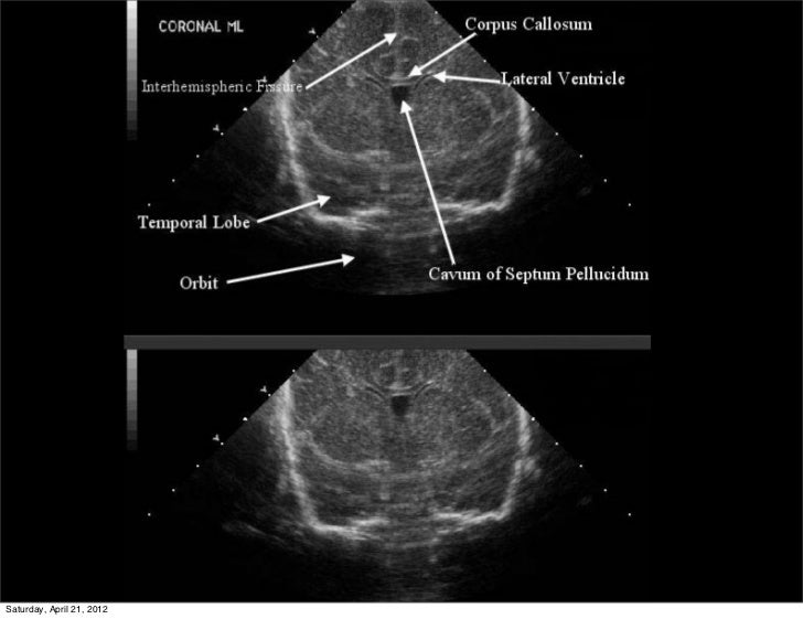 Neonatal Cranial Spinal Sonography