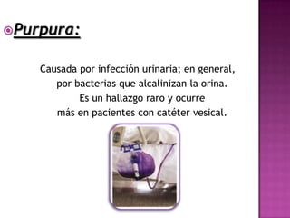 Purpura:


    Causada por infección urinaria; en general,
       por bacterias que alcalinizan la orina.
            Es un hallazgo raro y ocurre
       más en pacientes con catéter vesical.
 