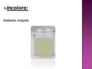 Incolora:


Diabetes insípida
 