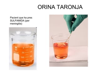 ORINA TARONJA
Pacient que ha pres
SULFAMIDA (per
meningitis)
 