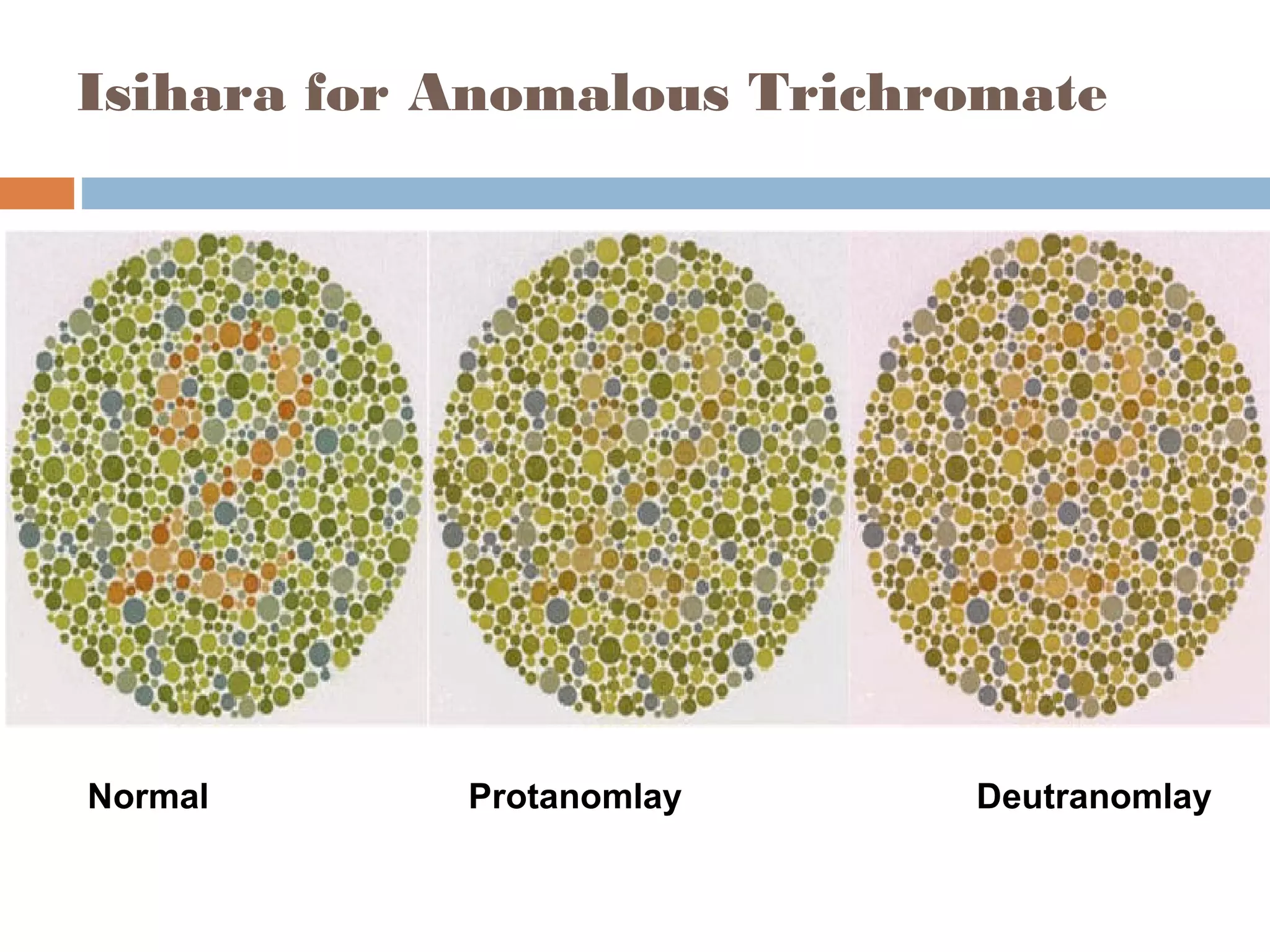 Isihara for Anomalous Trichromate
Normal Protanomlay Deutranomlay
 