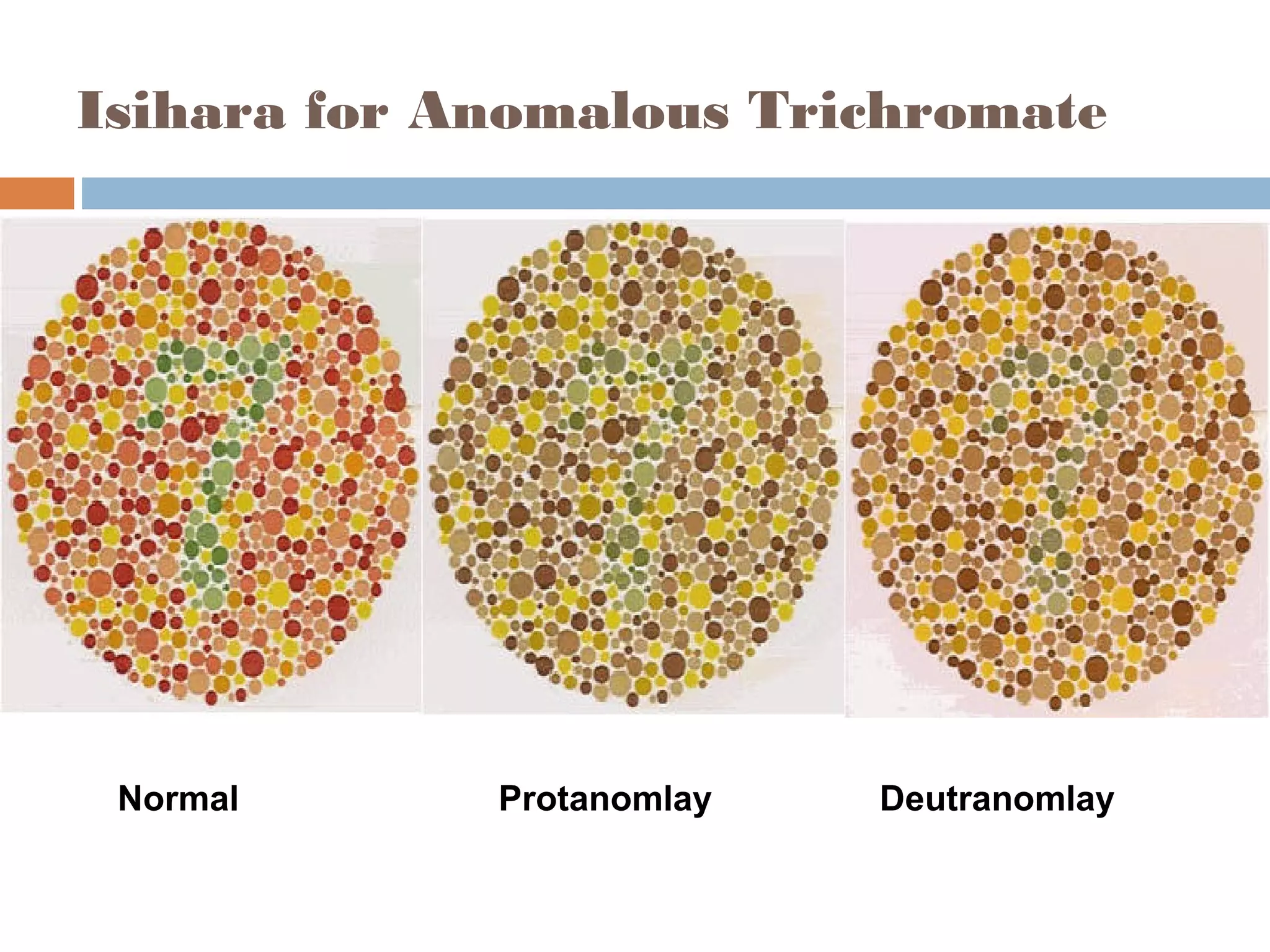 Isihara for Anomalous Trichromate
Normal Protanomlay Deutranomlay
 