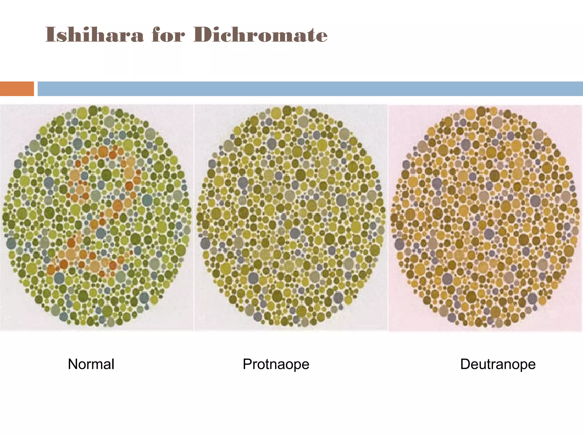 Ishihara for Dichromate
Normal Protnaope Deutranope
 
