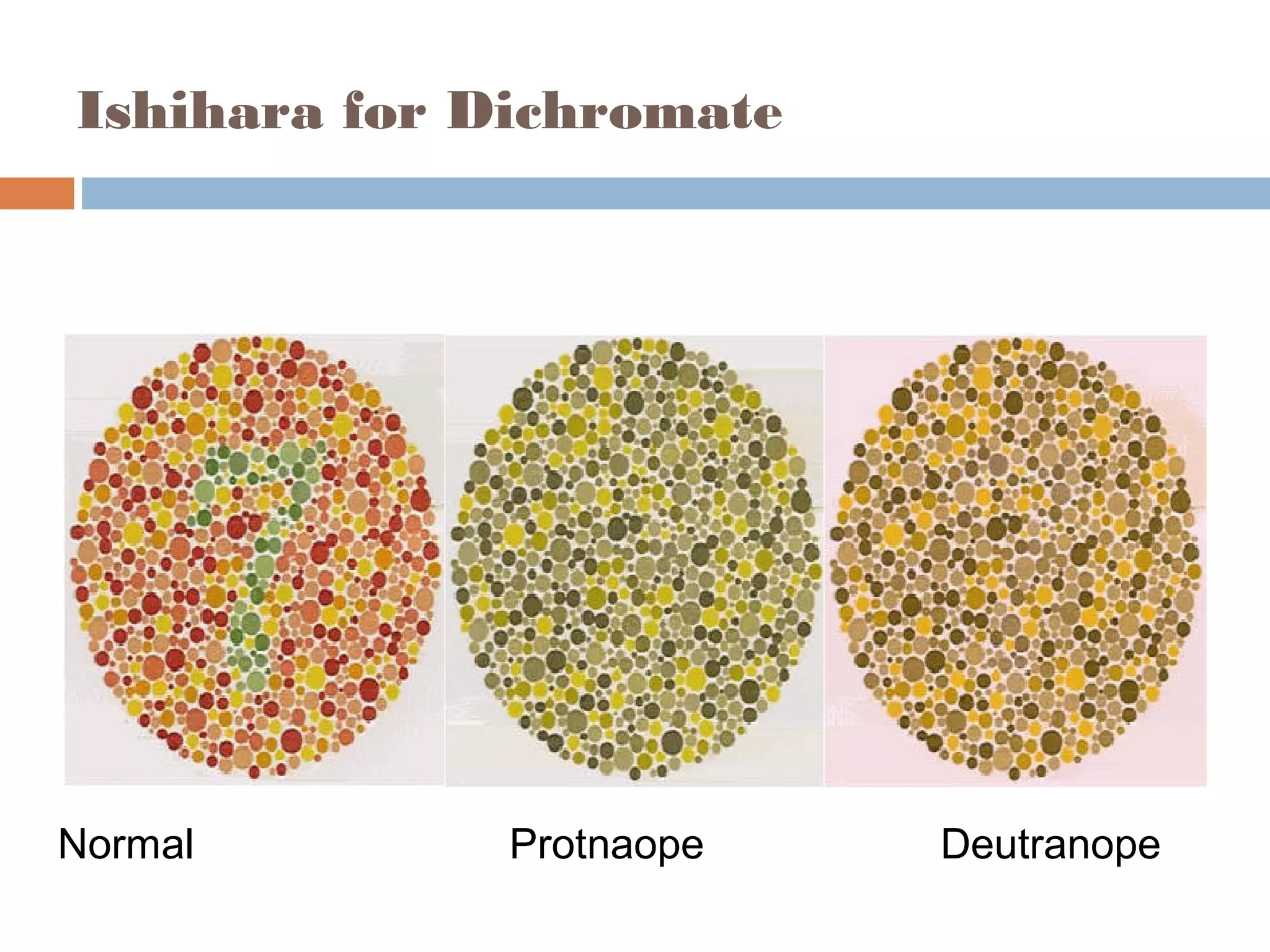 Ishihara for Dichromate
Normal Protnaope Deutranope
 