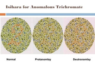 Trichromate Color vision physiology, defects and different testing Procedures | PPT
