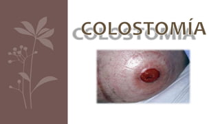 ¿QUE ES?
Colostomía:
Abertura en la zona del abdomen, como
resultado de un proceso quirúrgico, en el cual
una parte del co...