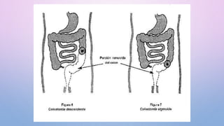 Síntomas
En muchos casos el cáncer de colon no presenta síntomas
pero si se llegarán a presentar seria:
•Sangre en las hec...