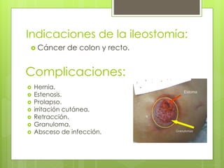 Indicaciones de la ileostomía:
 Cáncer de colon y recto.
Complicaciones:
 Hernia.
 Estenosis.
 Prolapso.
 irritación cutánea.
 Retracción.
 Granuloma.
 Absceso de infección.
 