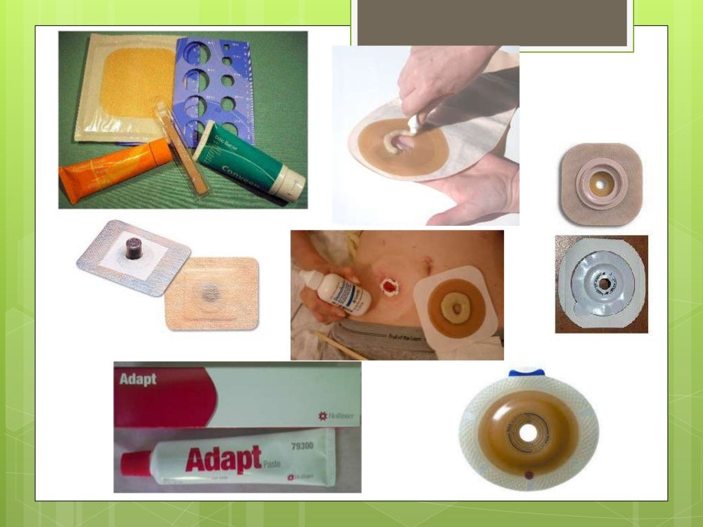 colostomia e ileostomia colostomia e ileostomia
