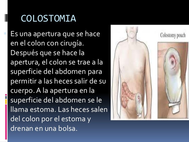 Colostomia