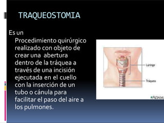 TRAQUEOSTOMIA
Es un
Procedimiento quirúrgico
realizado con objeto de
crear una abertura
dentro de la tráquea a
través de una incisión
ejecutada en el cuello
con la inserción de un
tubo o cánula para
facilitar el paso del aire a
los pulmones.
 