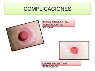 COMPLICACIONES
IIRITACION DE LA PIEL
ALREDEDOR DEL
ESTOMA

CIERRE DEL ESTOMA (
ESTENOISIS)

 