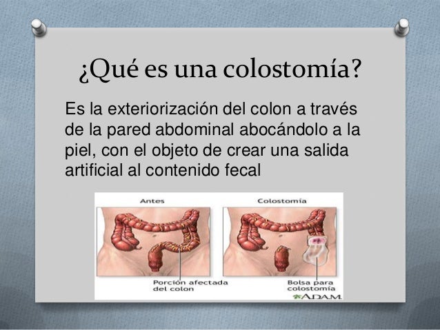 Colostomia