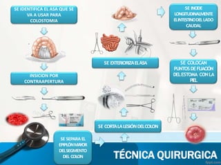 SE IDENTIFICA EL ASA QUE SE
VA A USAR PARA
COLOSTOMIA
INSICION POR
CONTRAAPERTURA
SE SEPARA EL
EPIPLÓNMAYOR
DELSEGMENTO
DEL COLON
SE CORTALALESIÓNDELCOLON
TÉCNICA QUIRURGICA
SE EXTERIORIZAELASA
SE INCIDE
LONGITUDINALMENTE
ELINTESTINODELLADO
CAUDAL
SE COLOCAN
PUNTOSDEFIJACIÓN
DELESTOMA CONLA
PIEL
 