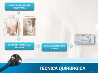 TÉCNICA QUIRURGICA
SE COLOCA BOLSA PARA
COLOSTOMIA
SE REALIZA HEMOSTASIA
RIGUROSA
SE REALIZA CIERRE POR
PLANOS
 