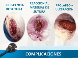 DEHISCENCIA
DE SUTURA
REACCION AL
MATERIAL DE
SUTURA
PROLAPSO +
ULCERACION
COMPLICACIONES
 