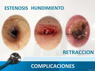 ESTENOSIS HUNDIMIENTO
RETRACCION
COMPLICACIONES
 