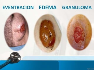 EVENTRACION EDEMA GRANULOMA
 