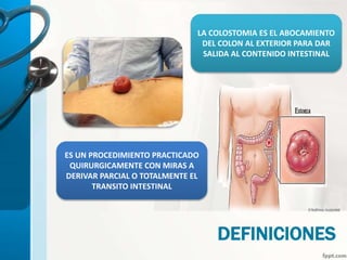 DEFINICIONES
LA COLOSTOMIA ES EL ABOCAMIENTO
DEL COLON AL EXTERIOR PARA DAR
SALIDA AL CONTENIDO INTESTINAL
ES UN PROCEDIMIENTO PRACTICADO
QUIRURGICAMENTE CON MIRAS A
DERIVAR PARCIAL O TOTALMENTE EL
TRANSITO INTESTINAL
 