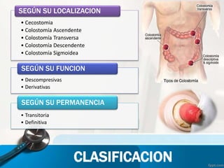 CLASIFICACION
• Cecostomia
• Colostomía Ascendente
• Colostomía Transversa
• Colostomía Descendente
• Colostomía Sigmoidea
SEGÚN SU LOCALIZACION
• Descompresivas
• Derivativas
SEGÚN SU FUNCION
• Transitoria
• Definitiva
SEGÚN SU PERMANENCIA
 