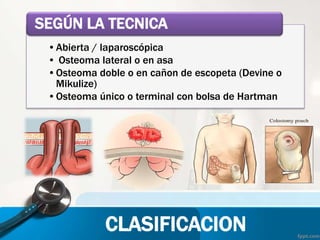 •Abierta / laparoscópica
• Osteoma lateral o en asa
•Osteoma doble o en cañon de escopeta (Devine o
Mikulize)
•Osteoma único o terminal con bolsa de Hartman
SEGÚN LA TECNICA
CLASIFICACION
 