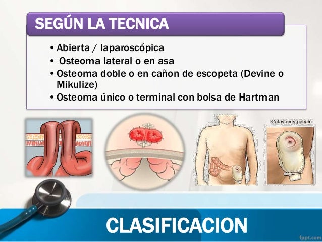 COLOSTOMIA TECNICA QUIRURGICA EPUB COLOSTOMIA TECNICA QUIRURGICA EPUB