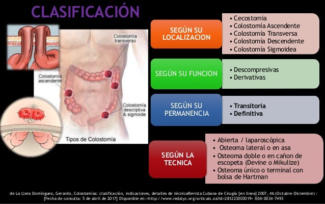 Colostomia