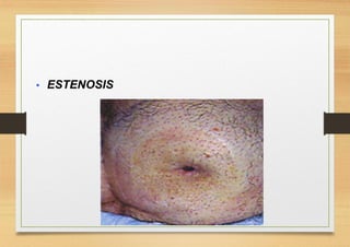  ESTENOSIS.
 