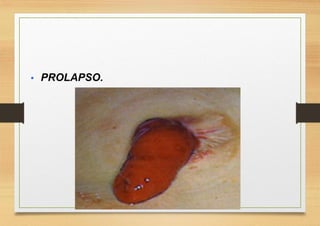  PROLAPSO.
 