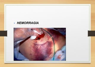  HEMORRAGIA
 