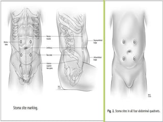 PREPARACION DEL SITIO DE
OSTOMIA
 Marcacion del sitio
 Disco en piel 2 cm de diametro
 Insicion
 Separacion longitudinal fibras musculares
 Clamp intestinal
 Cierre de pared abdominal
 Sangrado del estoma
 Maduracion 8 puntos
Principles and Practice of Surgery for the Colon, Rectum and Anus, Third Edition
 
