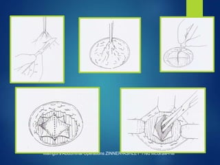 17
Maingot's Abdominal Operations ZINNER-ASHLEY 11ed McGraw-Hill
 