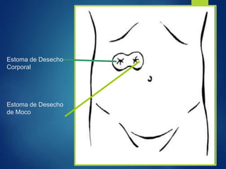 Estoma de Desecho
Corporal
Estoma de Desecho
de Moco
 