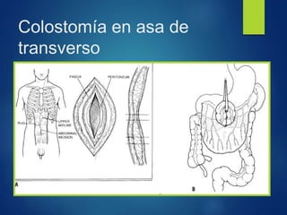 Colostomía en asa de
transverso
 