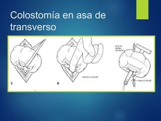 Colostomía en asa de
transverso
 