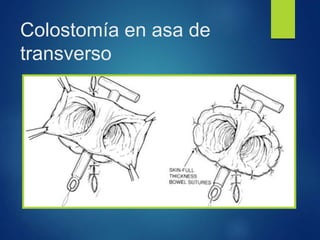Colostomía en asa de
transverso
 