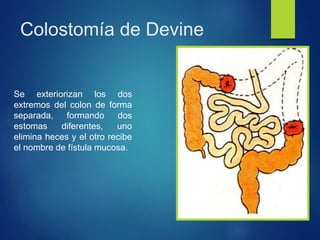 Colostomía de Devine
Se exteriorizan los dos
extremos del colon de forma
separada, formando dos
estomas diferentes, uno
elimina heces y el otro recibe
el nombre de fístula mucosa.
 