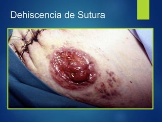 Dehiscencia de Sutura
 